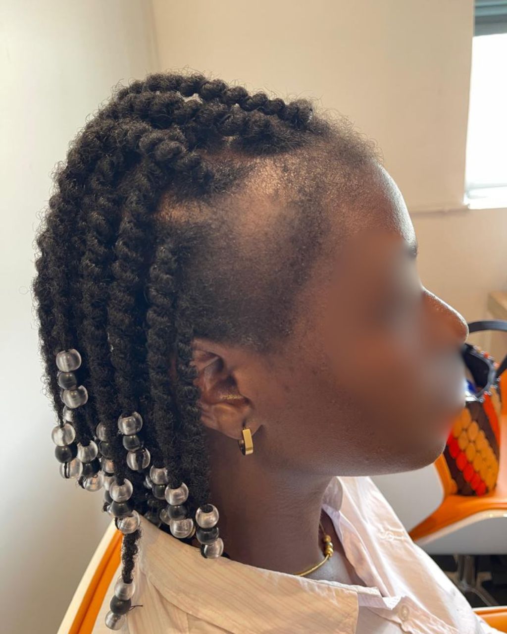 Patient's hair after curessa diagnosis and recommendation