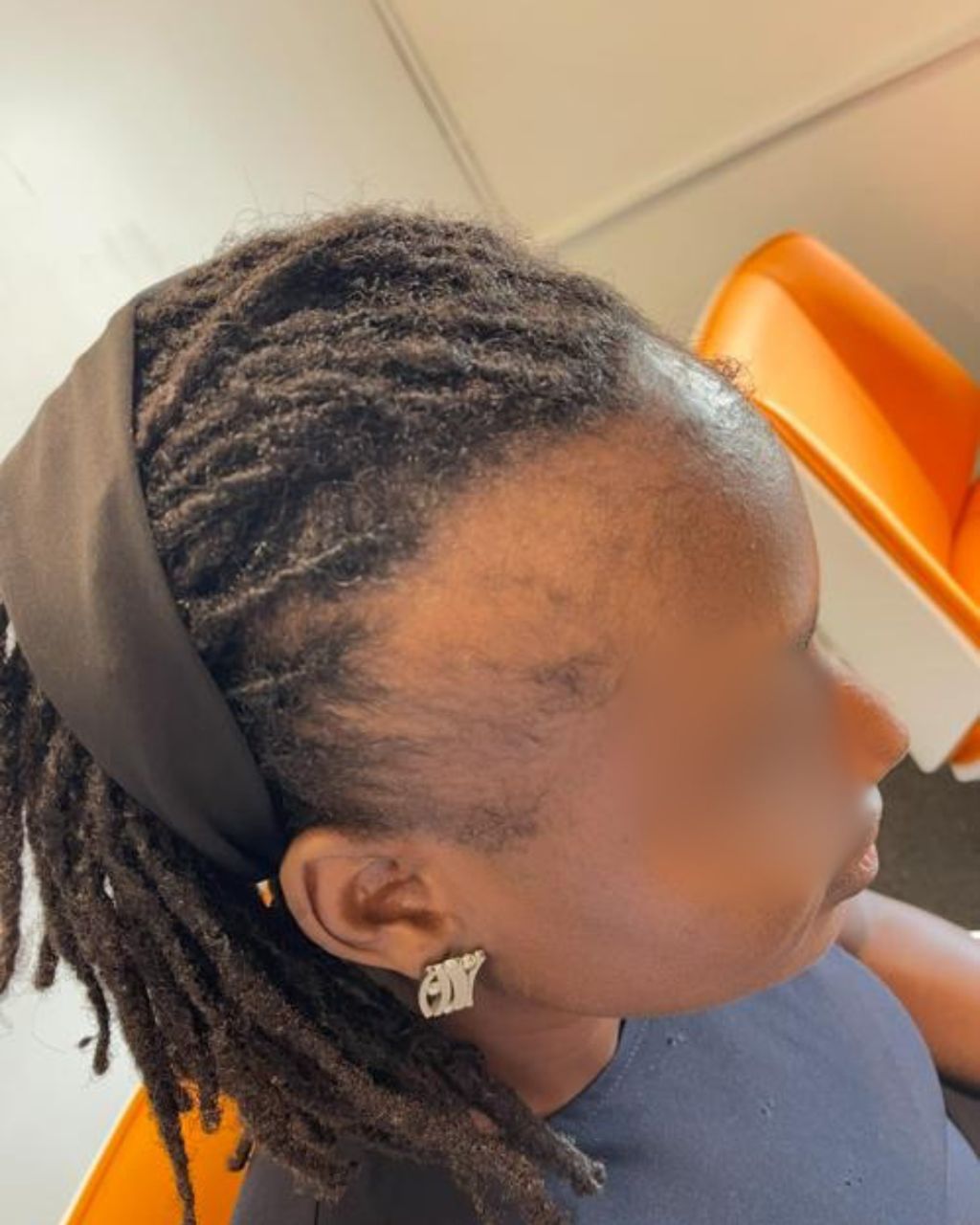 Patient's hair before curessa diagnosis and recommendation
